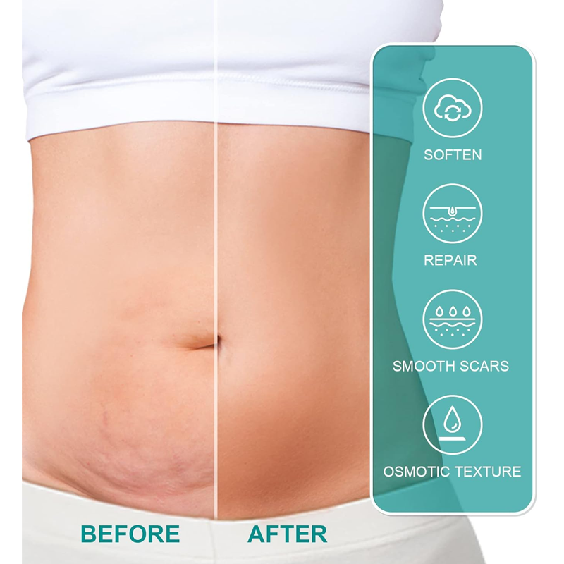 ScarRemove Advanced Scar Spray for All Types of Scars - Especially Acne Scars, Surgical Scars and Stretch Marks, Scar Removal, 100% Advanced Scar Remover Spray