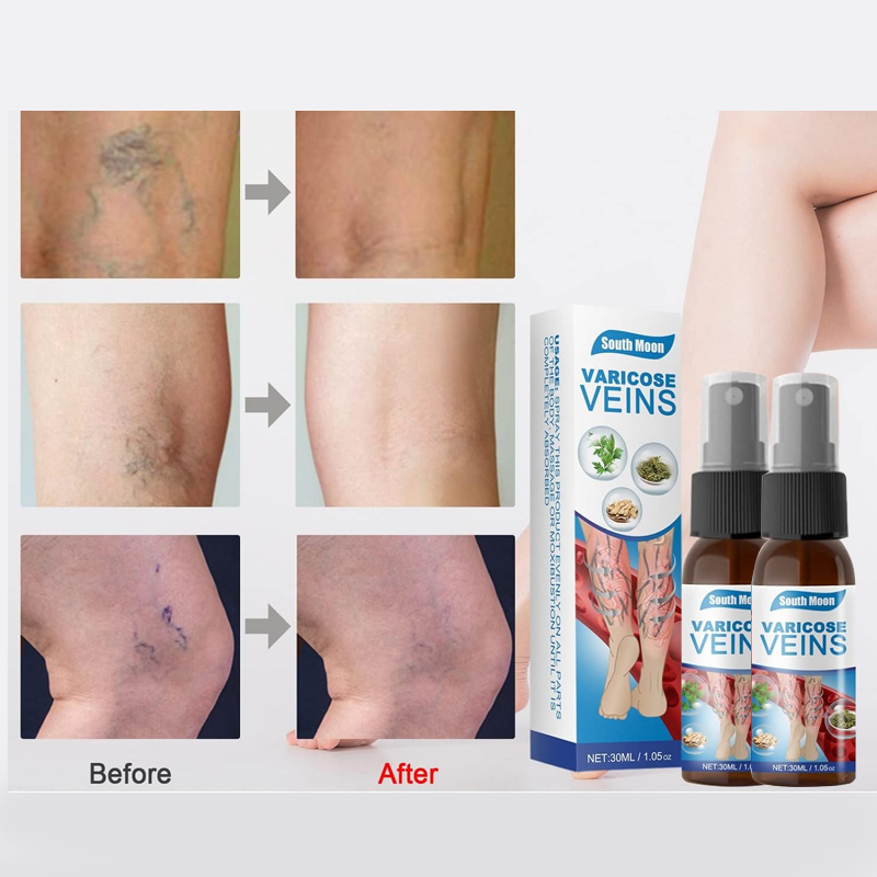Varicose Veins Treatment Spray – Natural Herbal Relief for Leg Vein Health – 2 x 30ML