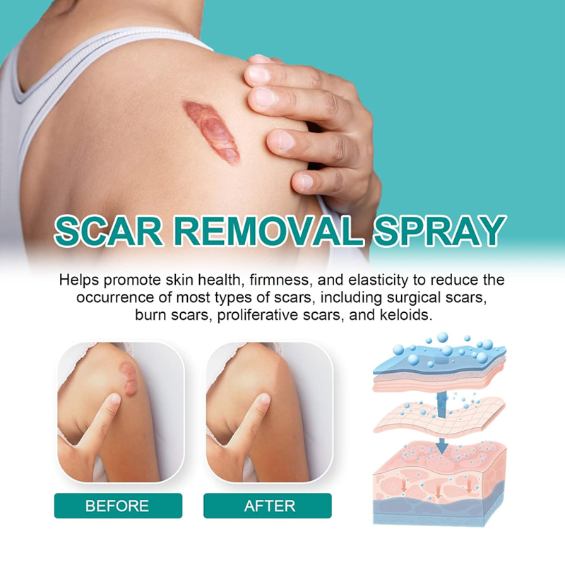 ScarRemove Advanced Scar Spray for All Types of Scars - Especially Acne Scars, Surgical Scars and Stretch Marks, Scar Removal, 100% Advanced Scar Remover Spray