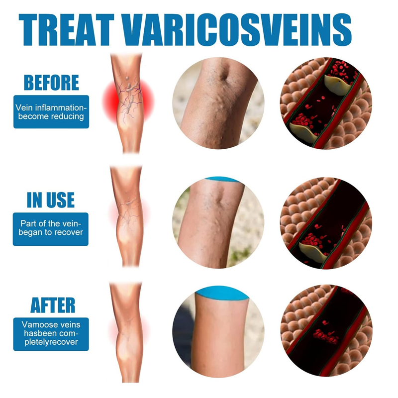 Varicose Veins Treatment Spray – Natural Herbal Relief for Leg Vein Health – 2 x 30ML
