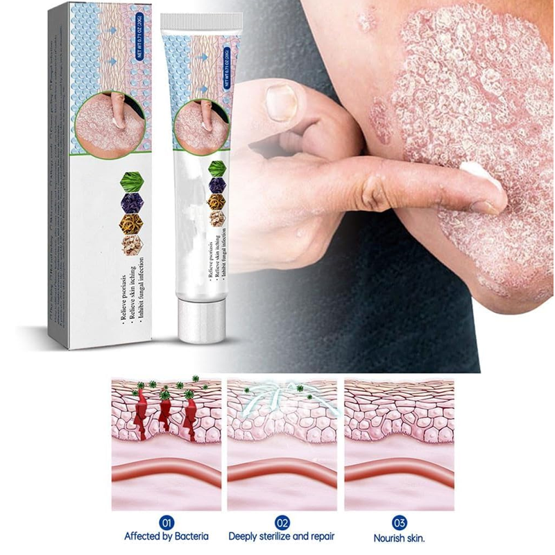 Skin Itch Relief Ointment Moisturising and anti-itch treatment skin protector for dermatitis itchy eczema psoriasis-2PCS