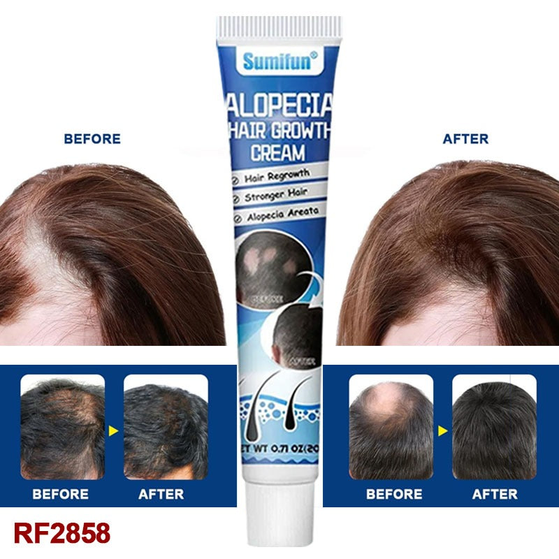20g New Alopecia Treatment Cream Hair Growing Prevent Alopecia Baldness Regrowth