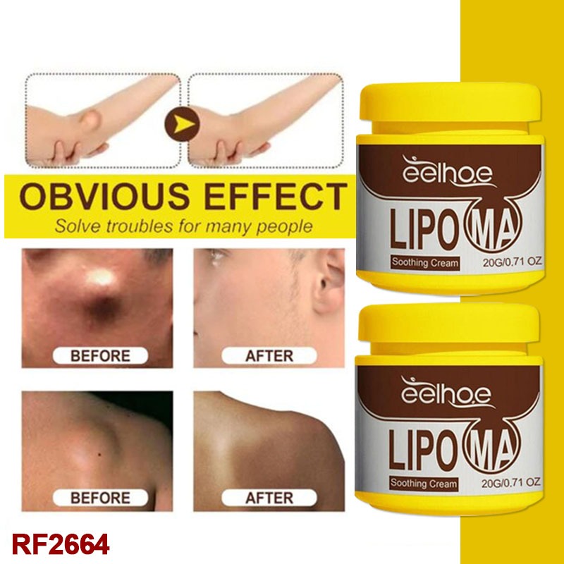 2PCS Lipoma Removal Cream,Natural Herbal Body Care Balm | Instant Lipoma Removal Cream Ointment for Subcutaneous Lumps and Various Fat Agglomerates, Relieving