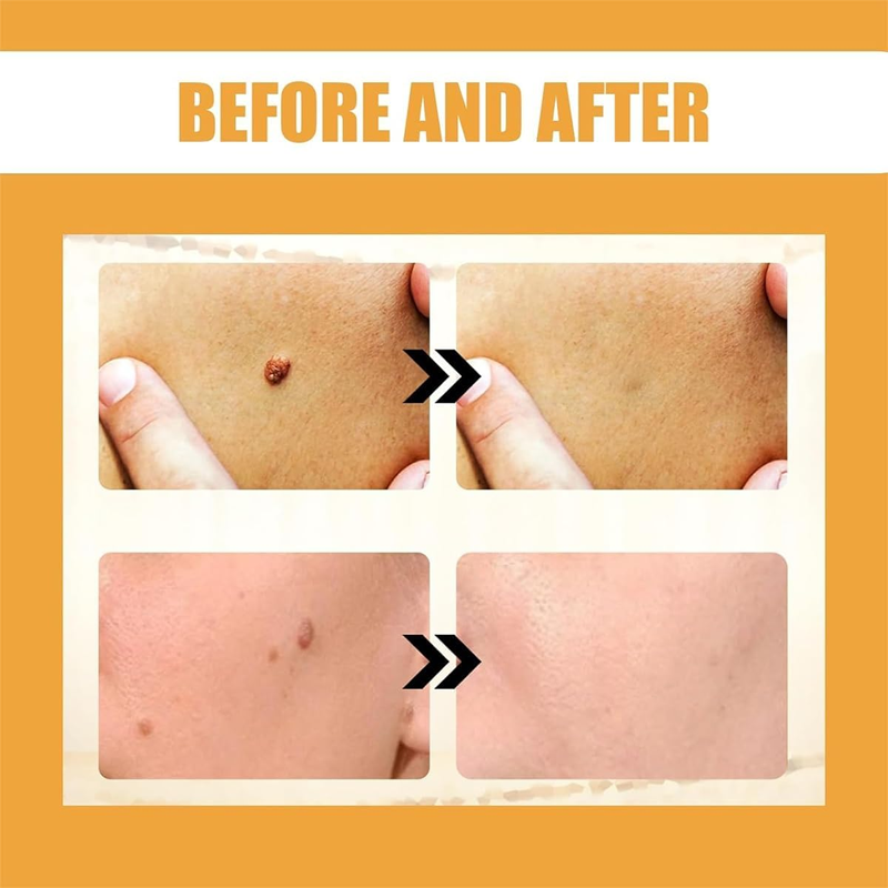 20g Portable Bee Venom Mole and Wart Treatment Cream, Bee Venom Mole and Wart Treatment Cream, Tag Recede Bee Venom for Skin, Bee Venom Cream for Women Men